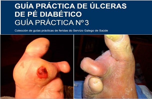 Guía práctica de úlceras do pé diabético. Guía nº3