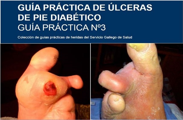Guía práctica de úlceras del pie diabético. Guía nº 3