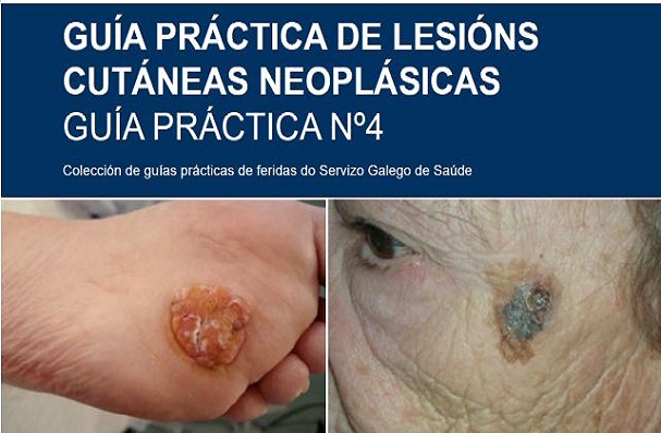 Guía práctica de lesións cutáneas neoplásicas. Guía nº4