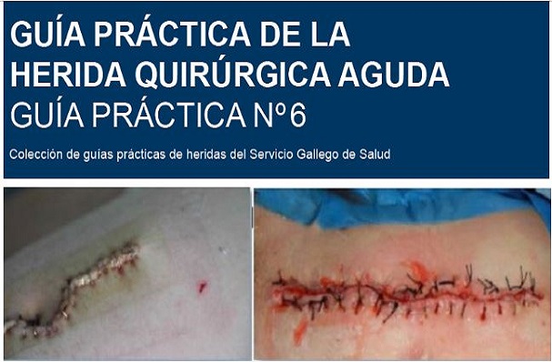 Guía práctica de la herida quirúrgica aguda. Guía nº6
