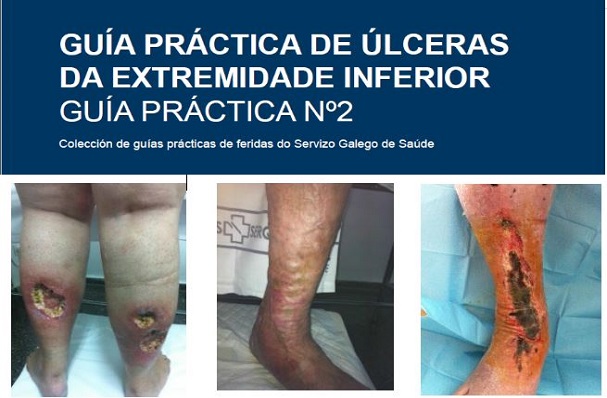 Guía práctica de úlceras de la extremidad inferior. Guía nº2
